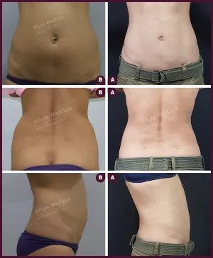Female Back Liposuction results