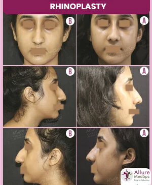 Rhinoplasty results, female nose