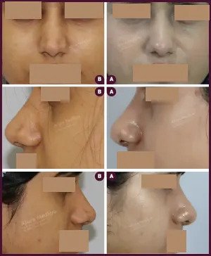 Twisted and Long Nose Rhinoplasty result