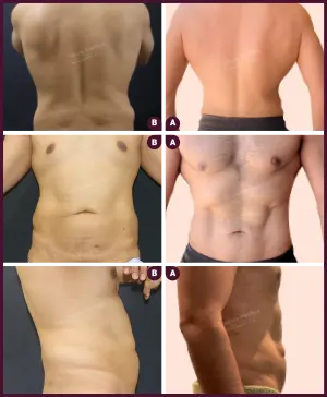 men-back-liposuction-before-and-after-image