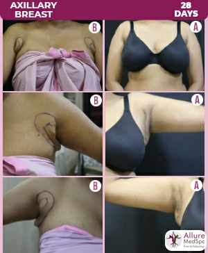 Real Patient Before and After results of breast augmentation surgery in mumbai at low cost