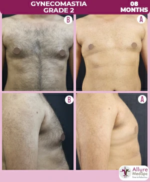 Gynecomastia, A Male Breast Reduction Surgery in Mumbai, India