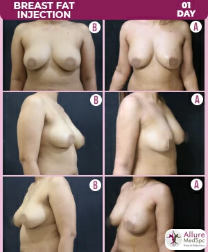 Breast implant surgery before and after result at best cosmetic surgery clinic in mumbai