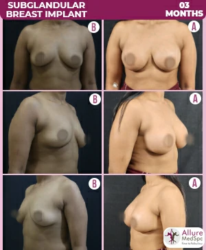 Breast augmentation before and after comparison, enhancing natural beauty