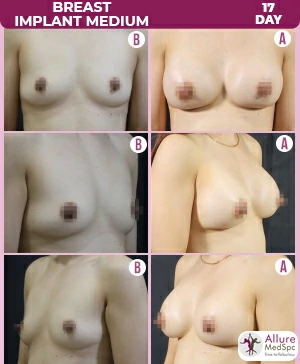 Breast augmentation surgery before and after images, see remarkable transformation