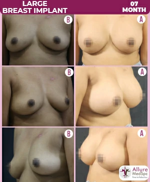 Breast augmentation surgery before and after comparison, amazing results at allure medspa