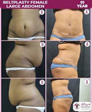 beltplasty surgery before and after image at Allure Medspa in Andheri, Mumbai.