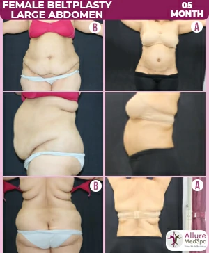 Image of a female patient's midsection before and after undergoing beltplasty surgery at Allure Medspa in Andheri, Mumbai.