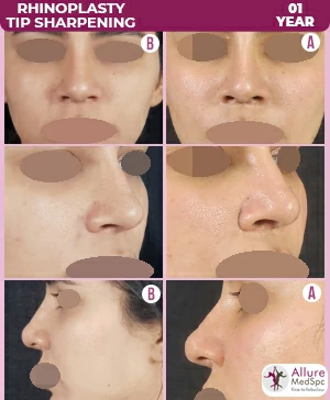 Image of a female patient's nose before and after undergoing rhinoplasty surgery to sharpen the nose tip at allure medspa in andheri, mumbai