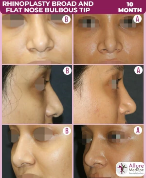 Lose Nose Fat - Get Slim Nose, Nose Reshaping Exercise