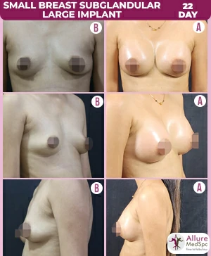 Breast implant surgery result in mumbai; see before and after images at allure medspa