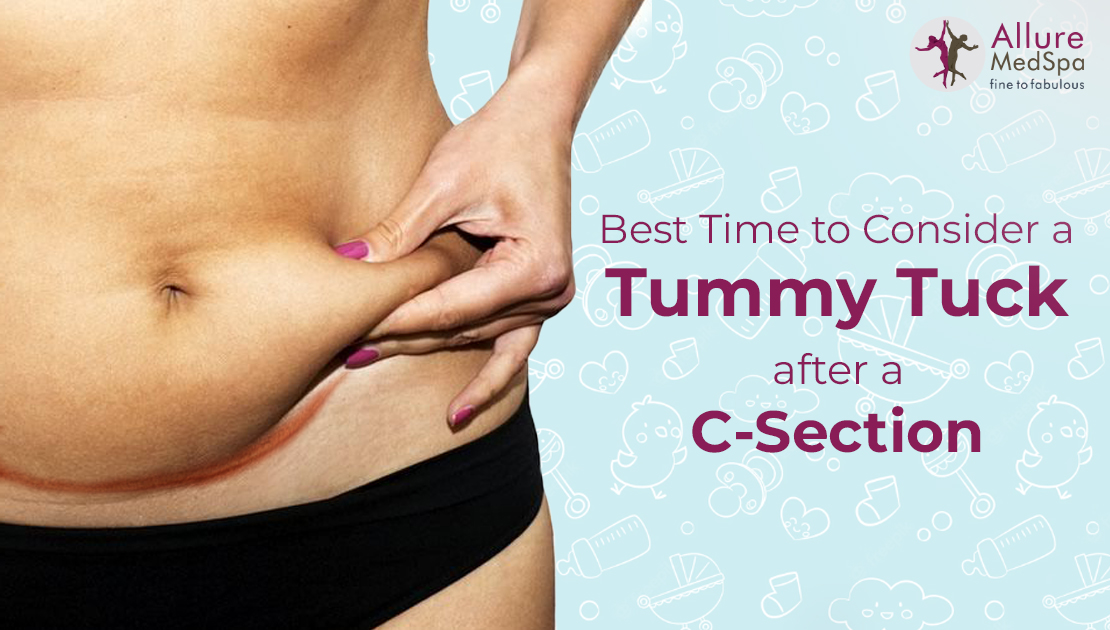 Best Time to consider Tummy Tuck surgery after Cesarean Section