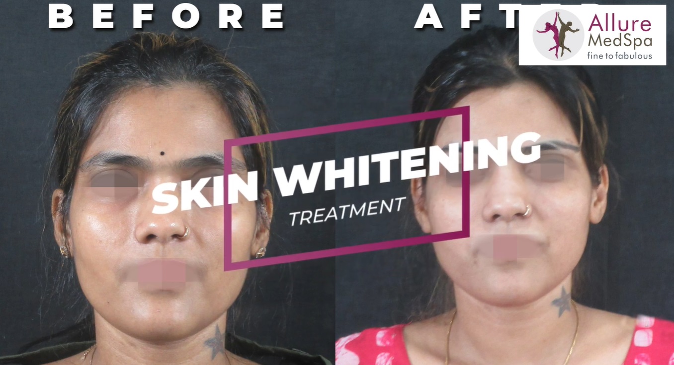 Skin Whitening Treatment Mumbai Testimonial Thumbnail