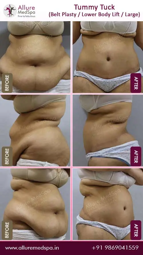 Body Lift & Loose Skin Surgery at Affordable Cost in Mumbai