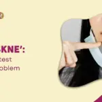 Maskne The Latest Skin Problem & How to Treat It