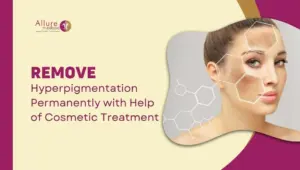 Remove Hyperpigmentation Permanently with Help of Cosmetic Treatment