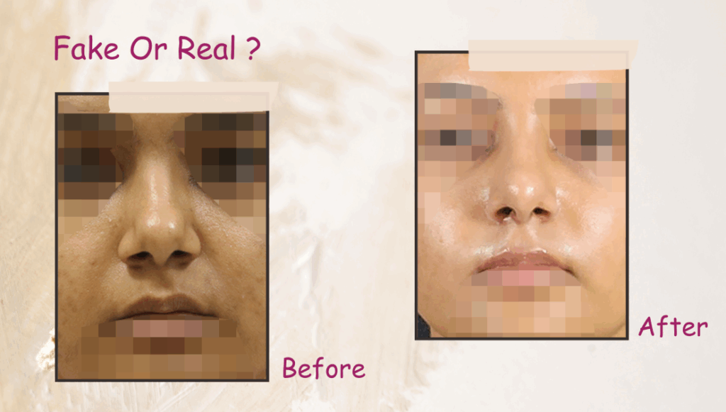 Are Rhinoplasty Before & After Images Real?