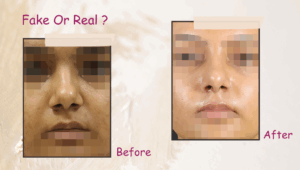 Rhinoplasty before after image are they real or fake?
