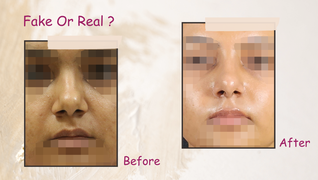 Rhinoplasty before after image are they real or fake?