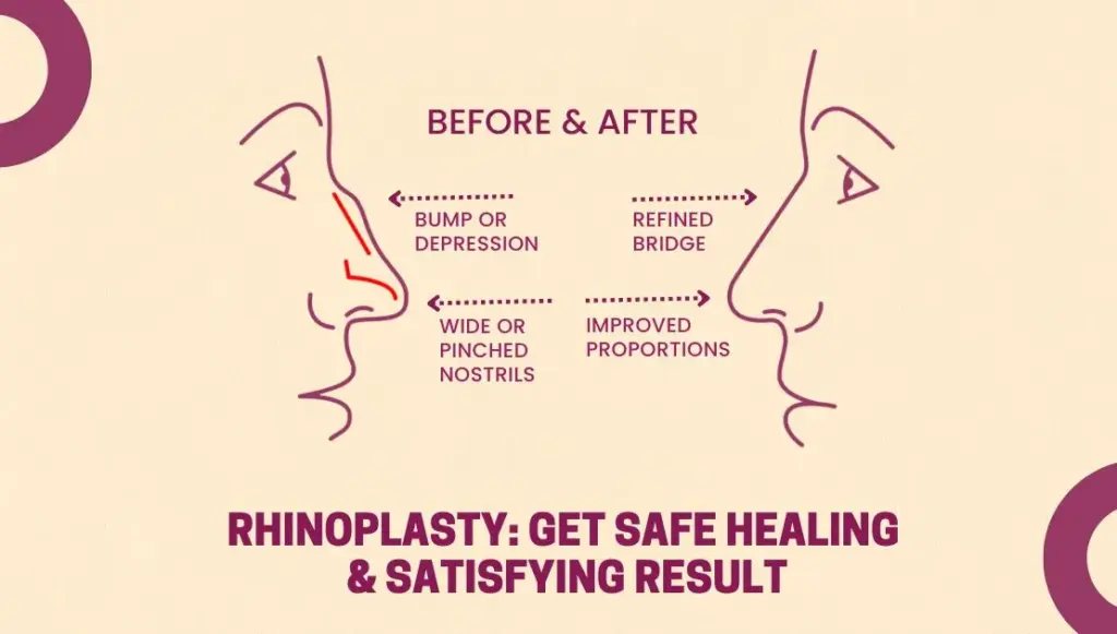 How to Avoid Risks & Get Smooth Healing Process After Rhinoplasty surgery