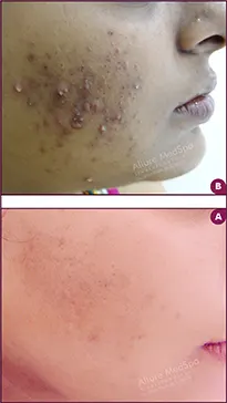 Acne Treatment 2 Acne treatment