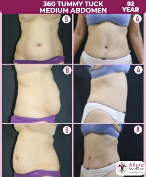 Tighten Your Abs with a Mini Tummy Tuck for Active, Fit Moms 2 360-Tummy-tuck-medium-abdomen (1)