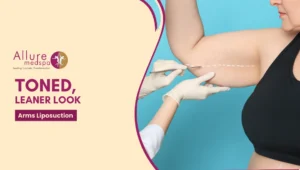 Arms Liposuction 300x170 1