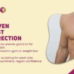 Asymmetrical Gynecomastia: Causes, Diagnosis & Customized Correction 2 Asymmetrical Gynecomastia- Causes, Diagnosis & Customized Correction