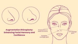 Augmentation Rhinoplasty
