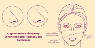 Augmentation Rhinoplasty
