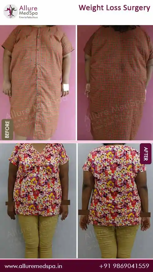 Bariatric Surgery 7 Bariatric-Surgery-Before-and-After-Images-in-Mumbai-India