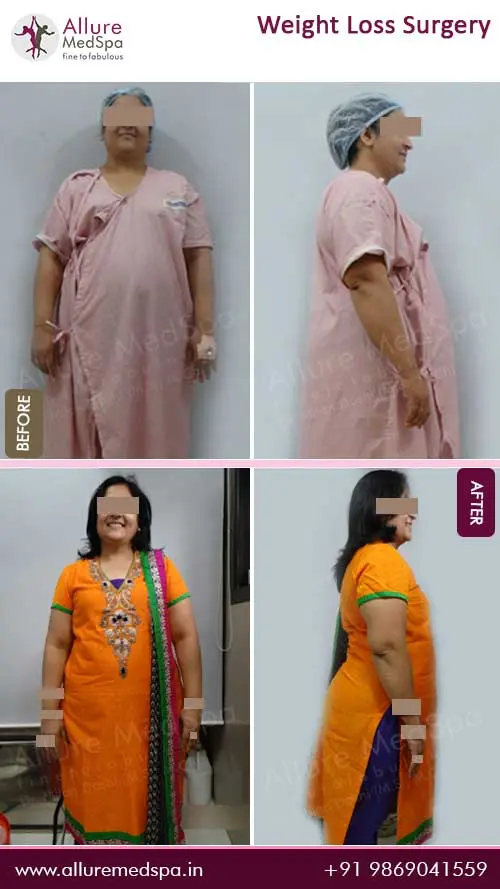 Bariatric Surgery 6 Bariatric-Surgery-Before-and-After-Photos-in-Mumbai-India