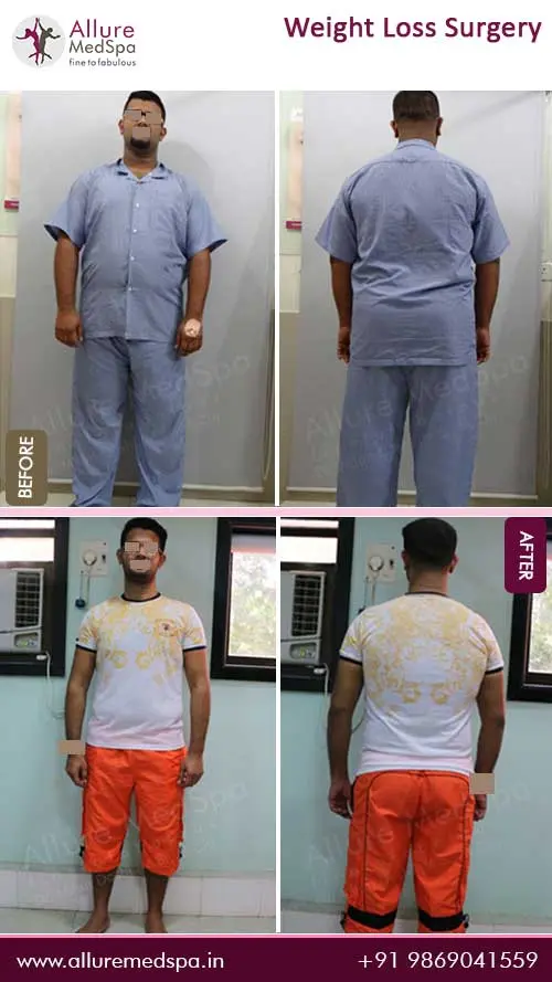 Bariatric Surgery 5 Bariatric-Surgery-Before-and-After-Pictures-in-Mumbai-India
