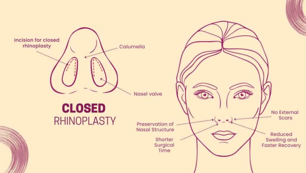 Closed Rhinoplasty: A Scarless Approach to a Balanced Nose