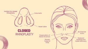 Closed Rhinoplasty