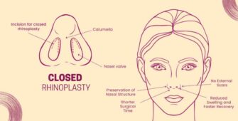 Closed Rhinoplasty