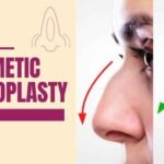 Cosmetic Rhinoplasty Surgery: Enhancing Beauty and Confidence 7 Cosmetic rhinoplasty