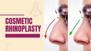 Cosmetic rhinoplasty