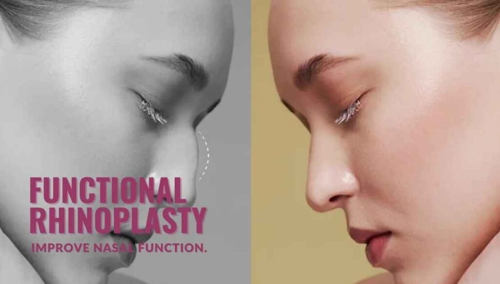 Functional Rhinoplasty: Enhancing Form and Function