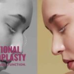 Functional Rhinoplasty: Enhancing Form and Function 8 Functional rhinoplasty