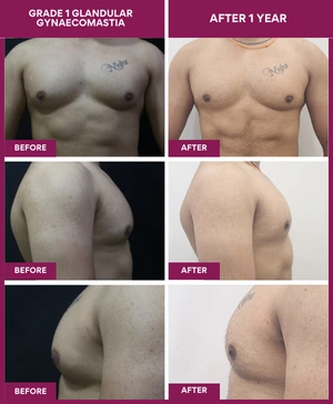 Gynecomastia Surgery Cost 5 GRADE-1-GLANDULAR-GYNAECOMASTIA (1)
