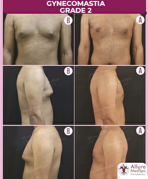 Gynecomastia Surgery Cost 10 GYNAECOMASTIA-GRADE-2.-MALE-BREAST-REDUCTION-SURGERY-RESULT-AND-COST-2 (1)