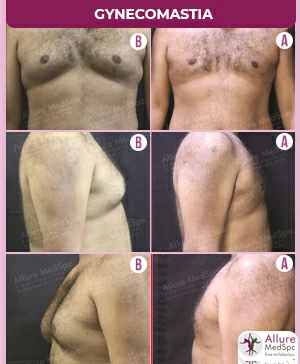 Gynecomastia Surgery Cost 6 GYNAECOMASTIA-GRADE-3-SURGERY-SKIN-TIGHT-RESULT-COST-IN-ANDHERI-WESTMUMBAI-INDIAGynecomastia