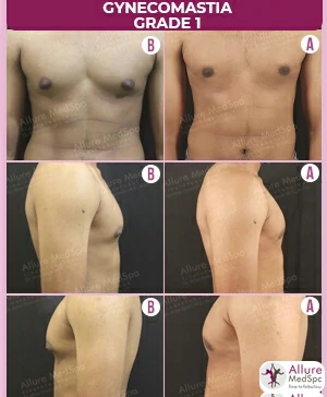 Gynecomastia Surgery Cost 12 GYNAECOMASTIA-SURGERY-1-.MALE-BREAST-REDUCTION-SURGERY-RESULT-AND-COST (1)