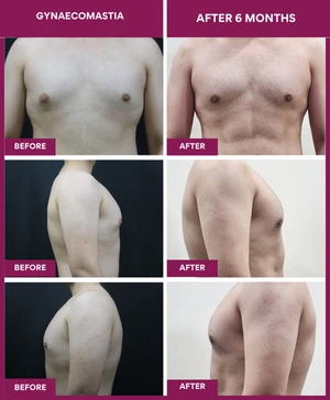 Gynecomastia Surgery Cost 14 Gynecomastia-Surgery-Result-after-6-month (1)