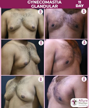 Gynecomastia Surgery Cost 7 Gynecomastia_Glandular