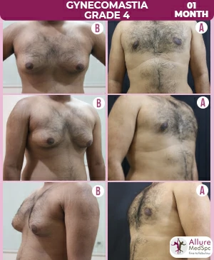 Gynecomastia Surgery Cost 8 Gynecomastia_Grade4