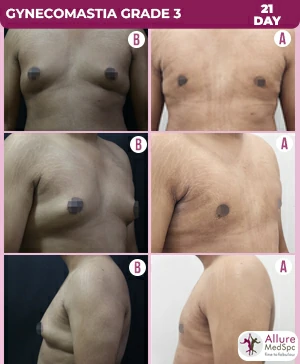 Gynecomastia Surgery Cost 11 Gynecomastia_grade_3