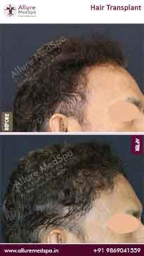 Hair-Transplant-Before-and-After-Gallery