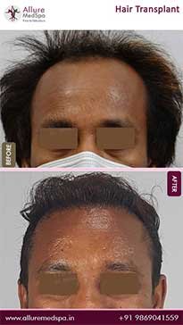 Hair-Transplant-Before-and-After-Pictures-in-Mumbai-India